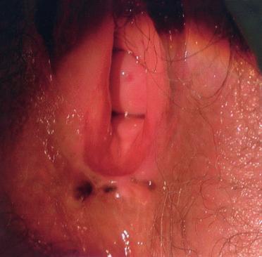 Histological procedures and criteria for diagnosis of oral lichen planus and vulval lichen planus Fig 4.