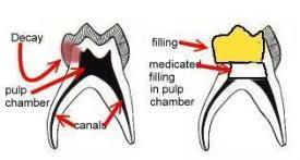 Pulp inflammation for which the dentist s own procedures are responsible