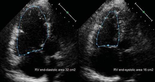 RV Fractional Area Change RV end-diastolic area 32 cm 2 RV end-systolic area 16 cm 2 32-16 FAC = = 50% 32 Recommended Measures of RV Function Summary of Reference Limits (2015)