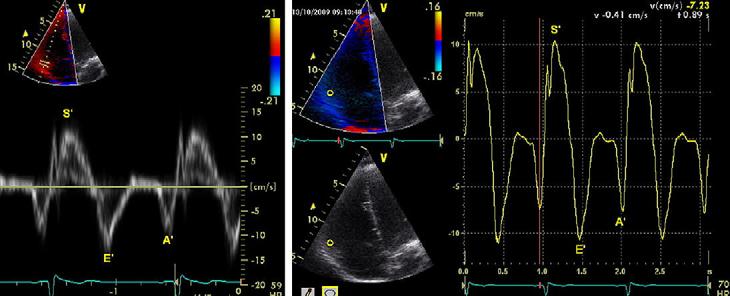 TDI of Tricuspid Annulus (normal RV systolic function) Evaluation of RV Systolic Function TDI of Tricuspid Annulus Simple rapid method Feasibility high (>95%) Primarily
