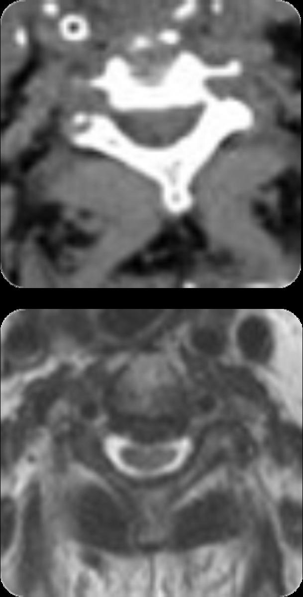 Fig. 8: No disc herniation was indicated by CT, while MRI