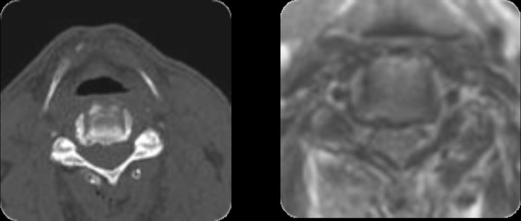 Fig. 3: Rrating of Luschka pathology bilateral by two methods.