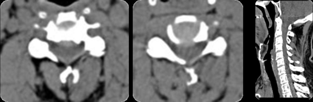 Fig. 5: Rating of the C3-C4 and C4-C5 hernias on CT as posterior central 2 (complete effacement of the subarachnoid space) Fig.