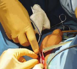 IMPLANTATION OF THE CUFF IV IMPLANTATION OF THE CUFF / SUTURE OF THE