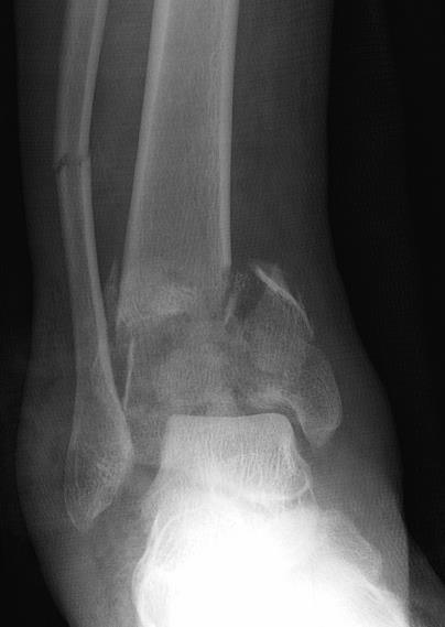 Definition High-energy fracture of distal tibial metaphysis Usually compressive