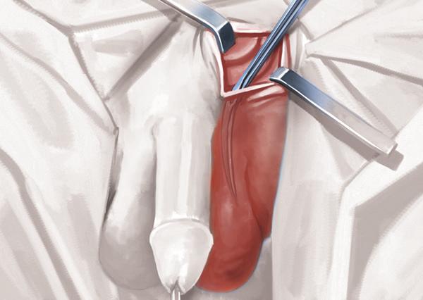 Dissect two centimeters of the urethra that is