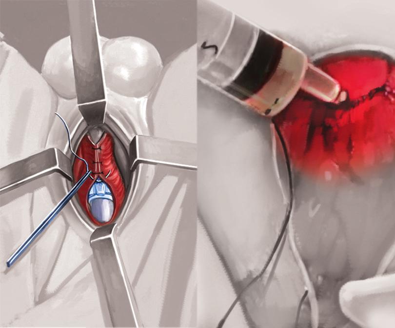 Insertion follows the same technique as implanting a testis prothesis.