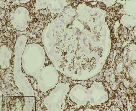 glomerular disease TGF-β 1 m-rna α-sma