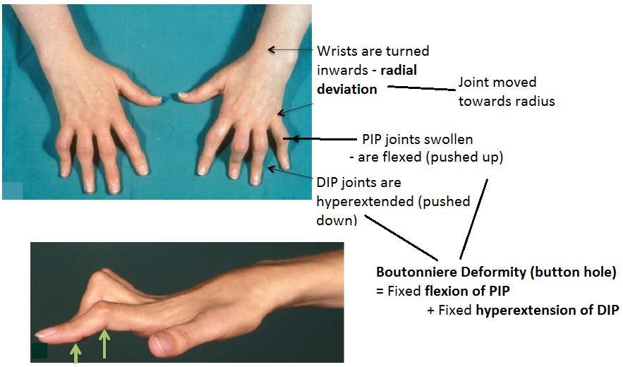 Boutonniere Deformity Mechanism of Boutonniere Deformity: Is a fixed contracture caused by splitting of extensor tendon along back surface of fingers