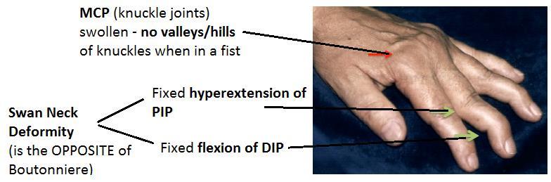 (is flexed) Can t be corrected except with surgery Swan Neck Deformity Mechanism of Swan Neck Deformity: Fixed contracture caused by splitting of