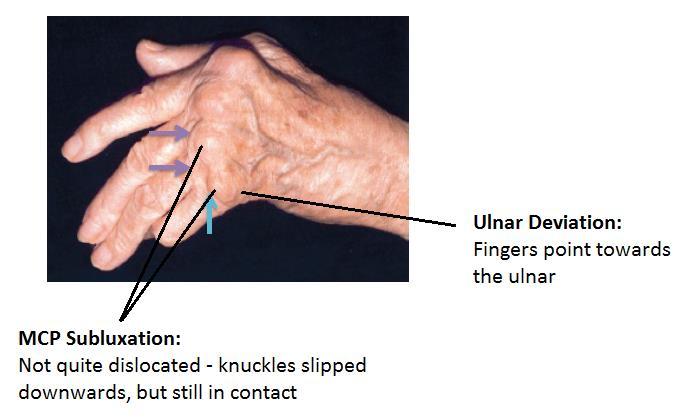 MCP Subluxation + Ulnar Deviation Mechanism for MCP subluxation/ulnar deviation: Seen in untreated, long standing RA Chronic inflammation around joints that have damaged surrounding structures around