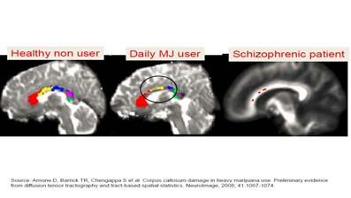 Marijuana causes damage to corpus callosum Increased risk of psychosis 19 20 Cannabis and psychosis
