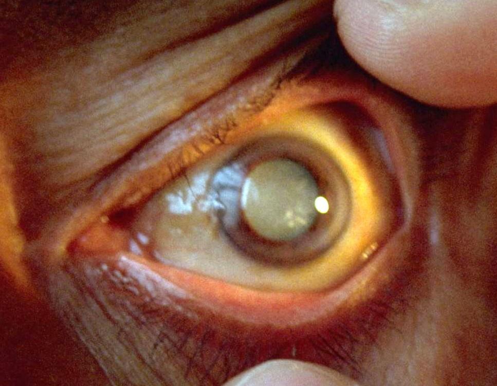 Blinding cataract Blinding