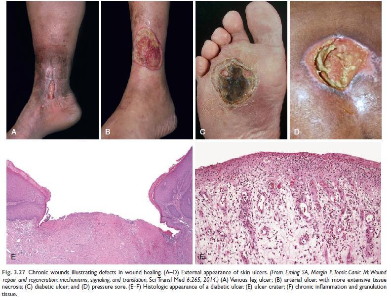 Abnormal Wound Healing Complications of tissue repair can arise from abnormalities in any of the basic components of the process, including deficient/excessive scar formation, formation of