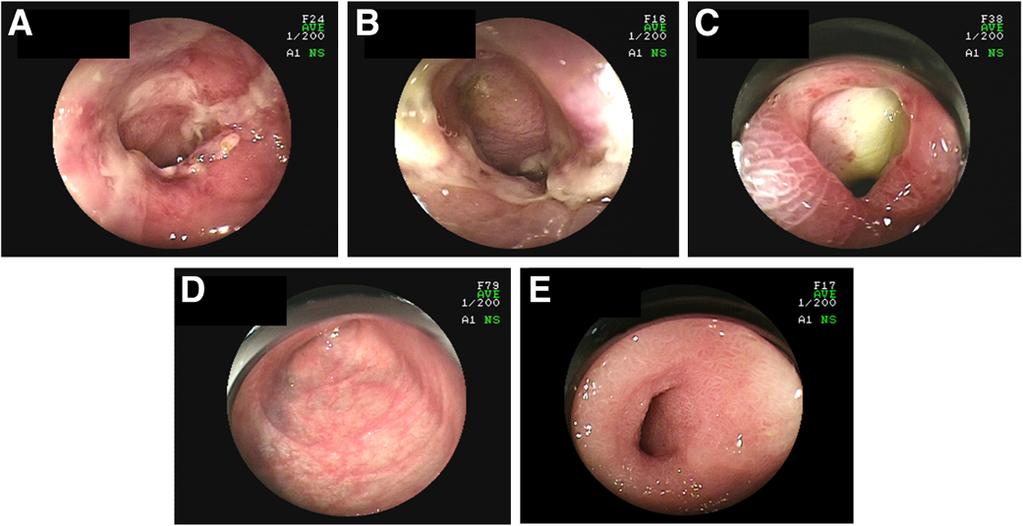 Fukushima et al. BMC Gastroenterology 2013, 13:42 Page 3 of 5 Figure 2 Endoscopic images of the small intestine before and after treatment. A: Longitudinal ulcer with redness and edema.