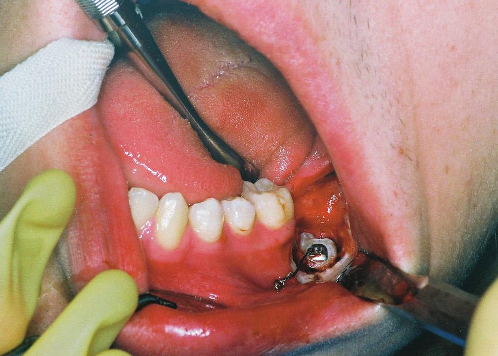 Figure 1. In the periapical view, 2 discrete globular opacities can be observed pericoronally, within the follicular space.