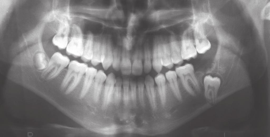 The panoramic radiograph shows an unerupted, inferiorly displaced mandibular second molar. Figure 3.