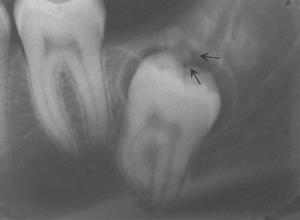 Because there was no soft tissue or bony expansion overlying these unerupted molars, the delayed eruption was considered to represent a unilateral but idiopathic anomaly.
