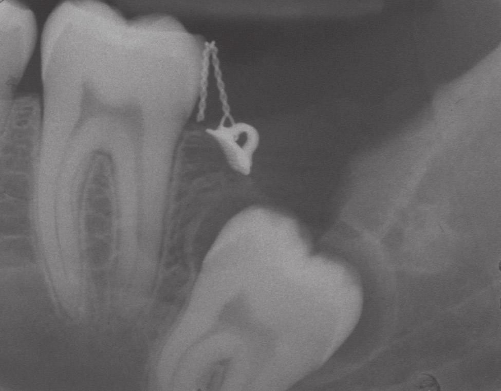 Figure 4. Macroscopic view of the lesion: oral mucosa, with underlying alveolar bone and the lesion overlying the tooth. Figure 5.