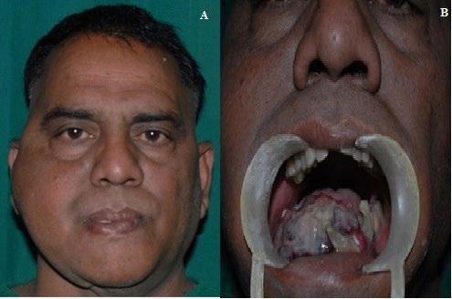 of mandible with more medio-lateral expansion measuring about 10 cm 8 cm 6 cm (Figure 1A). Neither paresthesia was associated with the swelling nor was any regional lymph node palpable.