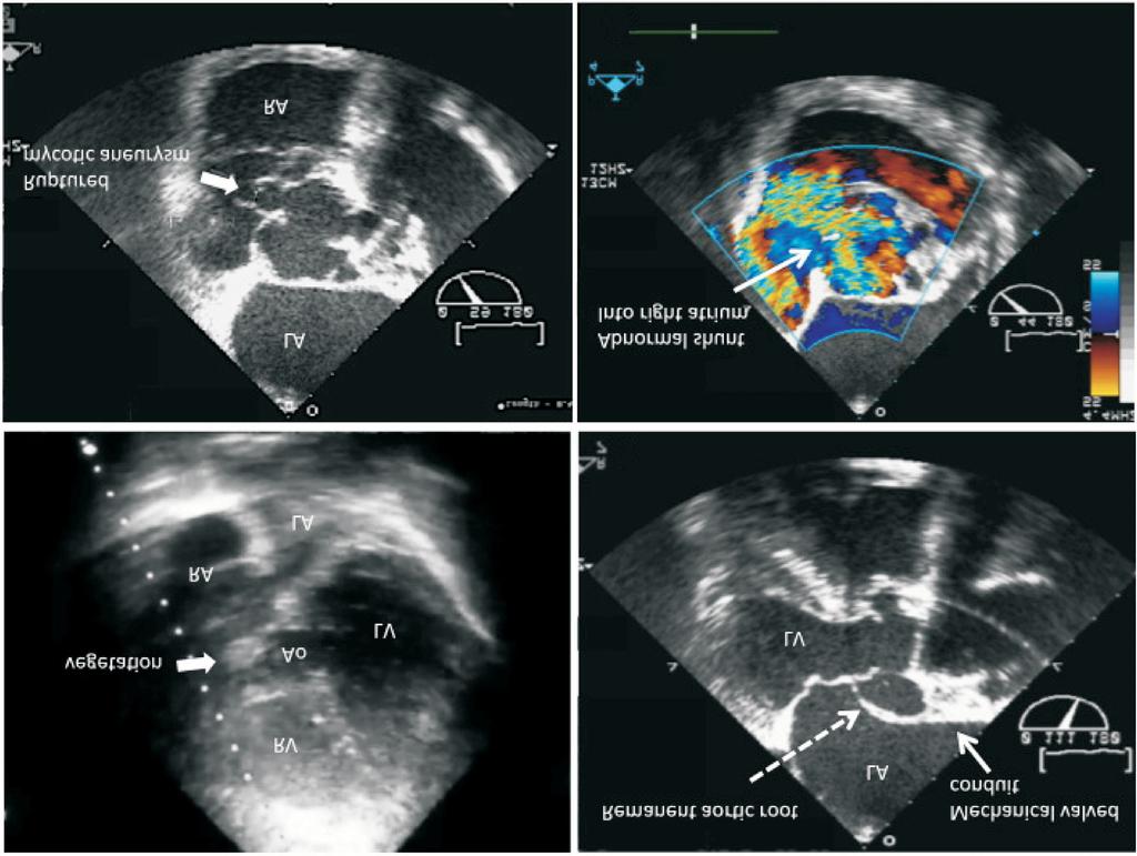 Mei-Ling Chen et al. procedure (open-chest transcatheter) using a Amplatzer duct occluder. CASE REPORT A 55-year-old man presented to our emergency department with a fever of 10 days duration.