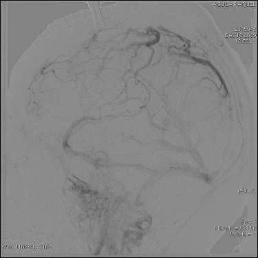 Acute intervention Patient has left subdural empyema with secondary extensive cerebral venous sinus thrombosis Seeding from untreated sinusitis Taken immediately to OR for left