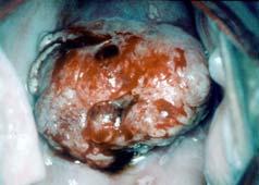 Protective Factors Cervical CA--Signs and Symptoms Cesarean section Circumcision