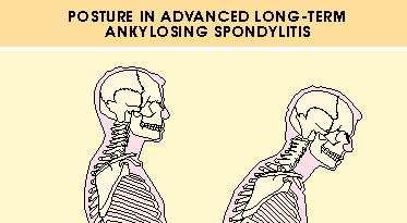 Posture in advanced longterm ankylosing spondylitis.