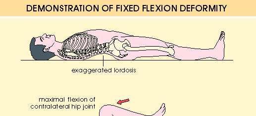 Fixed flexion deformity of the hip joint
