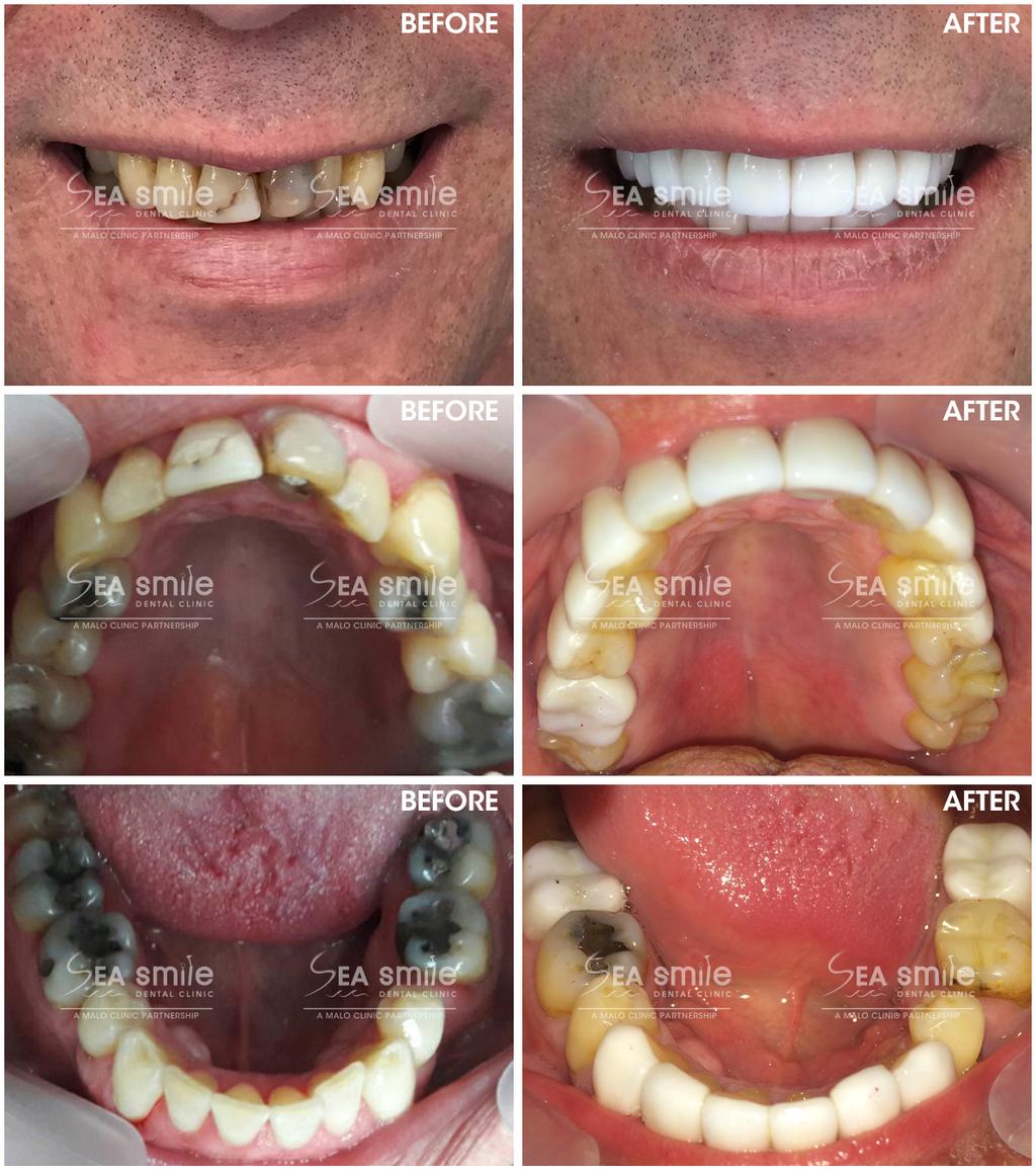 Before and After photos of patients who desired