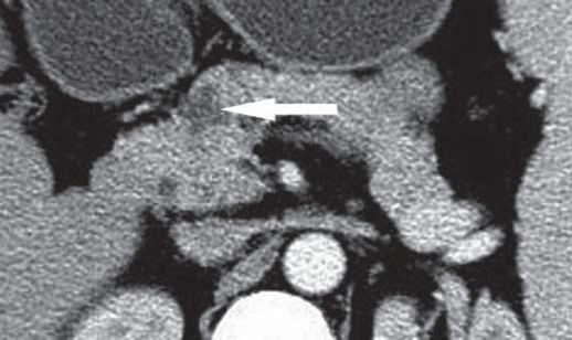 Differentiation of Pancreatic Ductal Adenocarcinoma from Serous Cystadenoma, Mucinous Cystadenoma and Pseudocyst on CT Scans Fig. 3.