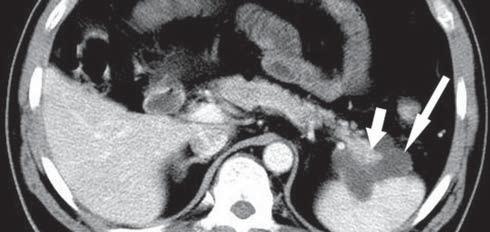 Image shows lobulated cystic lesion (arrow) in head of pancreas, which was surrounded by thin nonenhancing wall. well described in the literature.