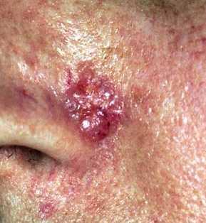Non-Melanoma Skin Cancer Most prevalent cancer worldwide Basal cell carcinoma (BCC): 80%