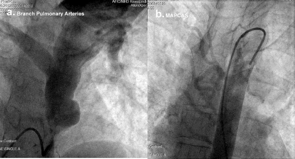 Figure 2: Stenting of adult female patient with re-coarctation Figure 3 a & b: RV out flow is opacified & MAPCAs are seen arising from upper thoracic aorta in TOF adult patient Complications