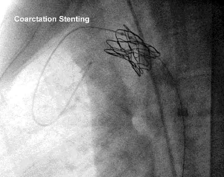 No mortality, cardiac perforation or local vascular access site complication occurred.