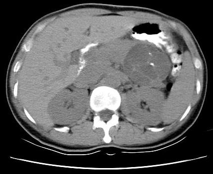 Imaging finding-ct 04/20 A well-defined, lobulated pancreatic tail cystic mass with thin septaes