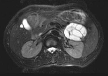 Imaging finding-mr T2W Cysts