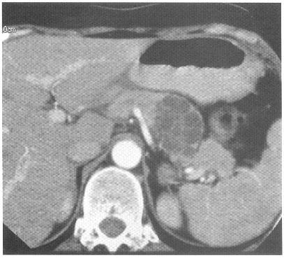 Microcystic (serous) cystadenoma Best imaging clue : Sponge-like mass in pancreatic head.