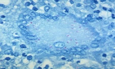 macrophages with multiple nuclei GRANULOMA =SUCCESSFUL TISSUE REACTION & HEALING