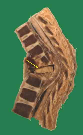 Can also be axillary BONES ONE THIRD INVOLVE SPINE From: Hematogenous spread