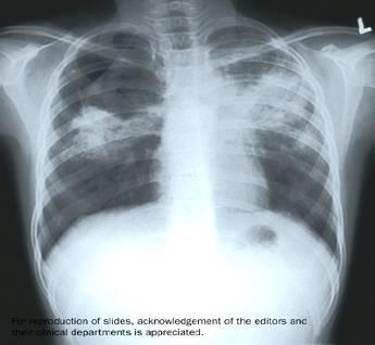 Chest X-Ray Upper lobe infiltrate with or without cavity Hilar adenopathy with or without infiltrates Pleural effusion, exudative Lower lobe infiltrate Miliary pattern UPPER LOBE INFILTRATE Apical