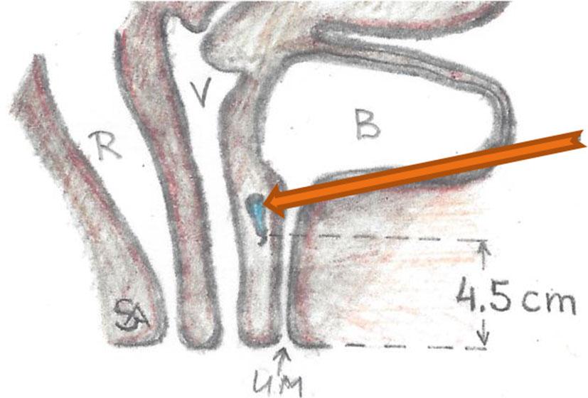 Increasing blood flow within the vaginal wall during sexual arousal was also reported in the medical literature [4].