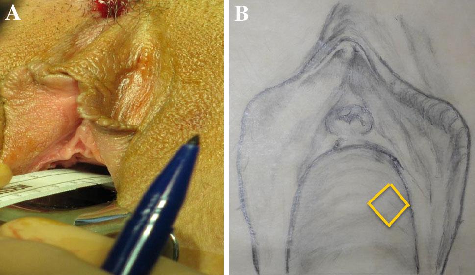 (Fig. 2b). This maneuver helps in determining the approximate amount of surgical fascia (the anterior vaginal wall adventitia) tissue to be excised (Fig. 2b). The intraoperative evaluation of the anterior distal vaginal wall for establishing the incision line is conducted (Fig.
