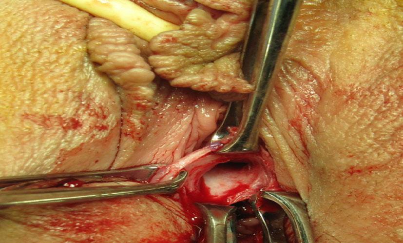 The incision is carried down through the submucosal and muscular layers of the vaginal wall until the vaginal surgical fascial tissue is exposed (whitish in color) (Figs. 3, 4 and 5).