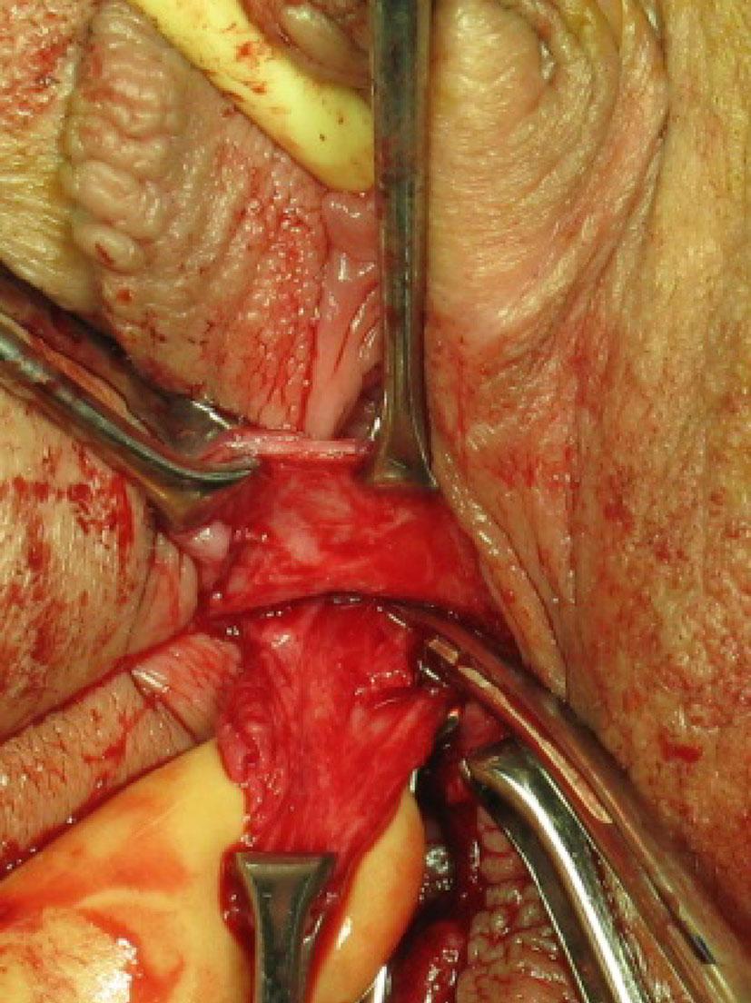 Fig. 8 Folded vaginal wall (lighter in color) after G-spotplasty completion Fig. 6 Excising a diamond shape of the vaginal surgical fascia five-year follow-up.