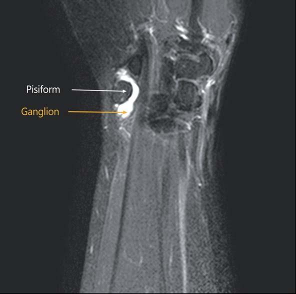 J Korean Soc Surg Hand Vol. 20, No. 3, September 2015 Guyon s canal with excision of the ganglion and transverse carpal ligament release were performed (Fig. 3).