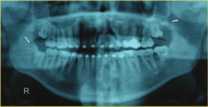 Balk J Stom, Vol 13, 2009 Supernumerary Molars 169 Clinical Study Case 1 A 32-year-old female patient presented for treatment of class III malocclusion, which was the result of the hereditary disease
