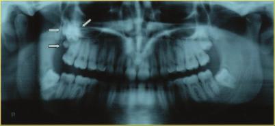 Case 2 A 24-year-old male patient with 2 fourth molars in the maxilla and 1 in the mandible (right) is under orthodontic treatment.