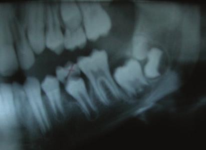 Case 4 A 27-year-old female patient was under orthodontic treatment 13 years ago.