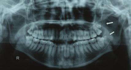 170 L. Ζouloumis et al. Balk J Stom, Vol 13, 2009 Case 6 A routine radiographic examination, in a 29-year-old female patient, revealed fourth molars both in the maxilla and the mandible (Figs.